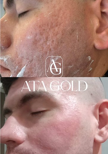 Resultados do Isaac ✨ Após 1 mês de ATA GOLD O ATA GOLD é uma solução poderosa para quem busca resultados duradouros e visíveis no tratamento de cicatrizes de acne 🙏🏻 Você quer conhecer esse procedimento? Comenta aqui ATA GOLD para mais informações 👇🏼 #peeling #peelingquimico #tcl #ata #peelingdeata #cicatrizesdeacne #acne #belezafacial #skin #medico #atagold #peelingprofundo #peeling #ata #atagold #fy #fyp #fyy