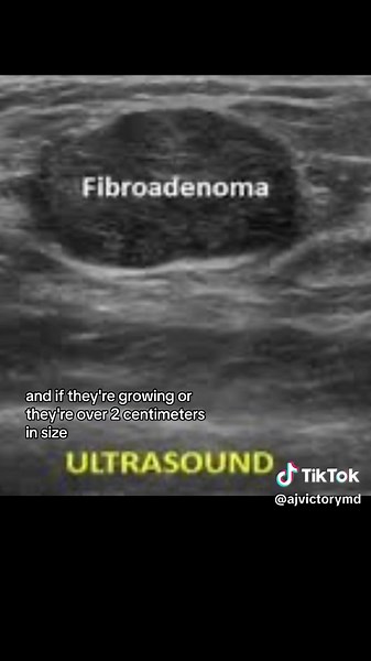 Understanding Fibroadenomas: Symptoms, Treatment, and More