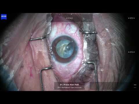 Intumescent Cataract, Mydricare XL & Isopure IOL