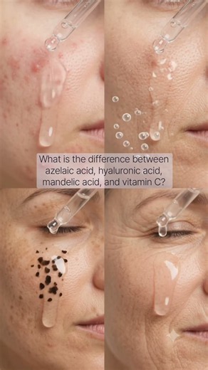 What is the difference between azelaic acid, hyaluronic acid, mandelic acid, and vitamin C?