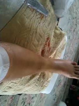 Broken Tibia & Fibula - no cast - Day 2