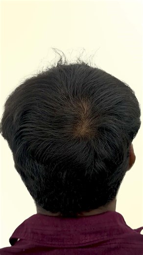 Hair Growth with GFC 😱 Before After Results 🔥
