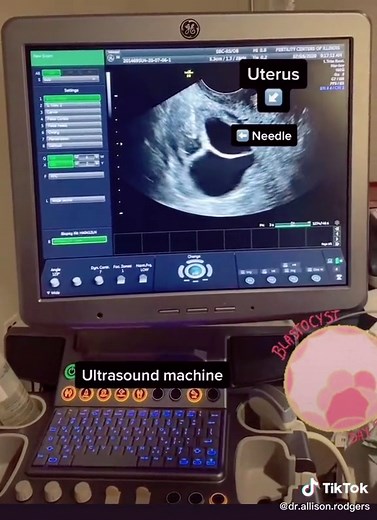 Understanding the Process of Egg Retrieval for IVF