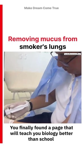 💉Removing mucus from 🚬smoker's lungs 🫁 | MDCT