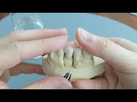 How to use lost filling and loose cap: Fallen off crown tutorial