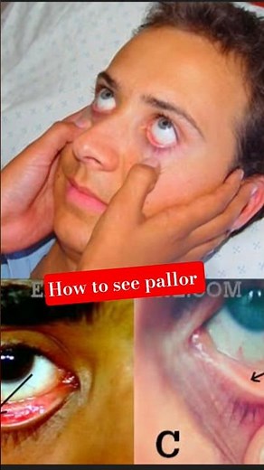 how to see pallor in general examination of patient #mbbs #practical