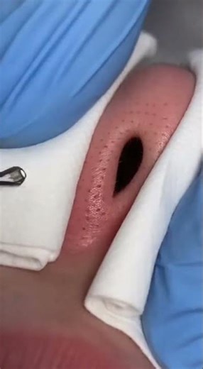 Massive Blackhead Extractions 😱 Deep Facial Treatment
