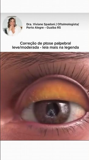 👁️ Correção de ptose palpebral leve a moderada