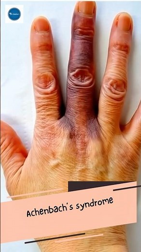 Dr Medica Clinical Case || Achenbach’s syndrome || Dermatology || Medical Knowledge