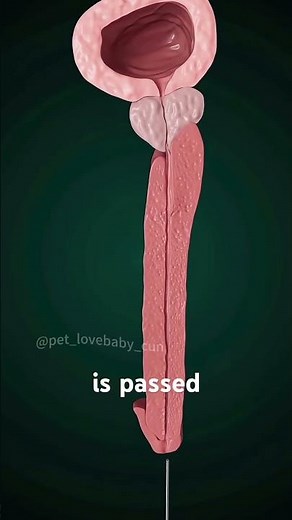 Enlarged Prostate Gland Surgery 3D Animation (Transurethral resection)#turp #transurethral