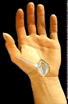 Carpal Tunnel Surgery