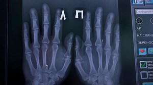 This doctor injected himself with microchips to make life simpler