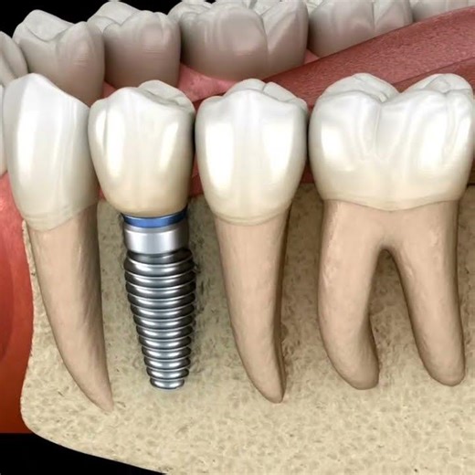 Implant ചെയ്യുന്നതിന് മുൻപ് #shorts #dental #reelsvideo #reels #malayalam