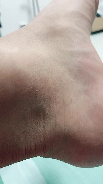 Foot Heartbeat: Causes, Symptoms, and Treatment