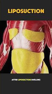Liposuction Surgery Explained | Procedure explained #medicaleducation
