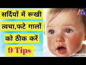 बच्चों की फटे गाल और त्वचा की देखभाल कैसे करें ।। 9 Home Remedies ।।Winter Skin Care Tips for Babies