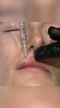 My vertical lip injection technique