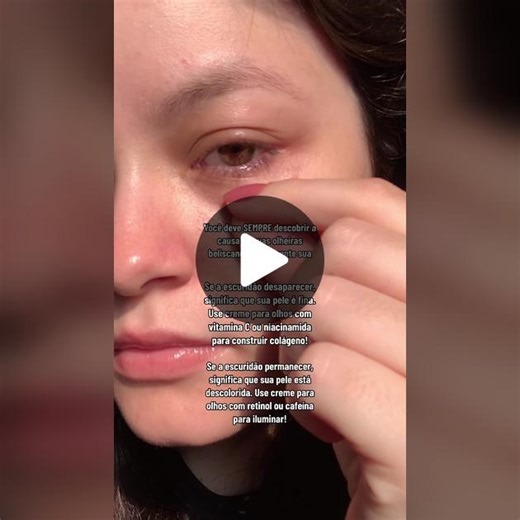 Como descobrir qual seu tipo de olheira? Ps:lembrando que existe vários tipos de olheiras e os tratamentos são diversos (o que está no vídeo pode não funcionar para você), por isso sempre consulte um dermatologista! IB: @Dani #olheirasescuras #darkcircles #hiperpigmentacao #skincare #darkcirclesundereyes