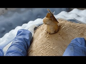 [ASMR] Huge Armpit Blackhead Extraction – Dr. Pimple Popper’s Most Satisfying Removal Ever! 0755