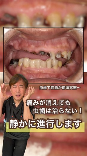 Cavities Don't Heal Just Because the Pain Stops... They Progress Silently! #NakanoDentalClinic #O...