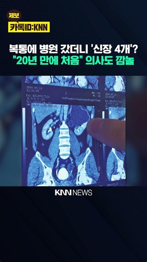 "20년 의사 생활 중 처음 본다" 선천적 신장 4개…"신기하다" / KNN
