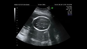 Ultrasound Baby Stock Footage Video (100% Royalty-free) 23415214 | Shutterstock
