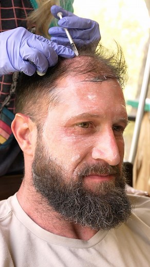Ryan Humiston | This SAVED my hair… #stemcell #hairloss #hairlosstips | Instagram
