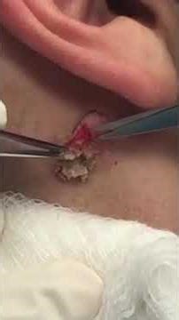 Quiet patient but I think happy with the results. Mom was definitely happy 😉⁠ #drpimplepopper