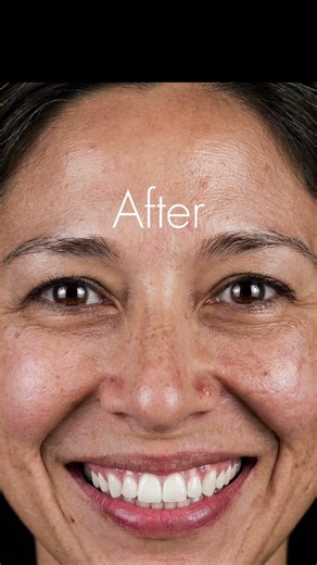 🦷 From Nervous to Comfortable — Before & After