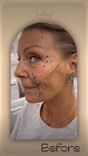 Radiesse Lateral Sculptra treatment A powerful collagen-stimulating combo to lift, sculpt, and rejuvenate the skin naturally. 📩Book your time for treatments via ling in the profile #luxurytreatments #malmöbeauty #aestheticclinic #fillers #helsingborg #wrinkles #lipfiller #danmark #radiesse #sculpture | Luxurytreatments T&L AB