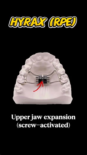 Orthodontic Expertise on Instagram: "Narrow upper jaw? Here are the main expanders you’ll see in orthodontics: Hyrax (RPE), Quad Helix, MARPE & SARPE. 🎥 Full breakdown is on my YouTube channel — check my bio / channel. — #orthodontics #braces #dentistry #teeth #orthodontist"