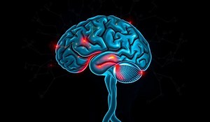 (SDAM) Severely Deficient Autobiographical Memory Is Not Amnesia