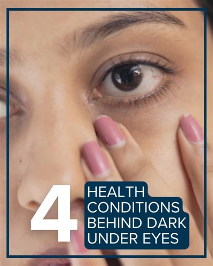 49K views · 55 reactions | Before you blame lack of sleep for your dark under eye circles, also known as periorbital hyperpigmentation, you may want to consider whether it stems from an underlying health condition. Learn what treatment is recommended: https://bit.ly/4nnBmHp | Aurora Health Care | Facebook