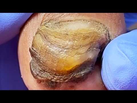 Black, Grimy Nails Look Like A Pagoda! Professional Cleaning.