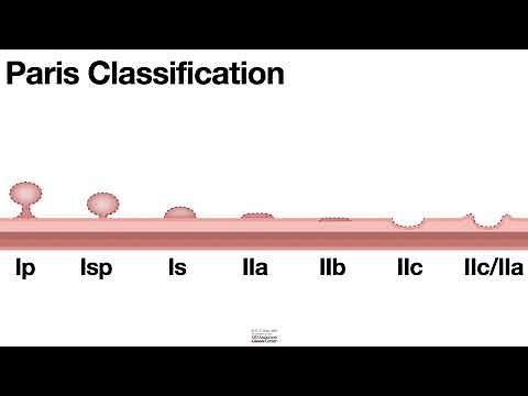 HCC 1475 9 Colon Polyp Classification