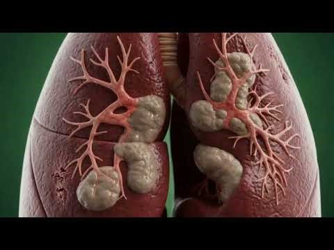 “Tuberculosis (TB): What Happens Inside Your Lungs?”