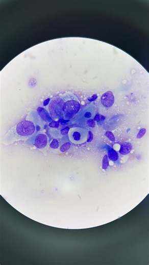 Mustafa Elsobky on Instagram: "SCC “Squamous Cell Carcinoma” / Cytological Features Report ✨🔬 : 1) large, pleomorphic epithelial cells with prominent Anisokaryosis. 2) Hyperchromatic Nuclei with prominent Nucleoli. 3) Cells with angular shapes and dense cytoplasm, characteristics seen in keratinized cells. 4) Individual cell keratinization (cells with eosinophilic cytoplasm and dense, pyknotic nuclei). 5) Some cells appear to have perinuclear clearing or vacuolization, which also seen in SCC."