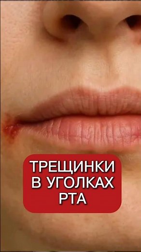Cracked corners of the mouth! How to get rid of them. Why do angular cheilitis occur?