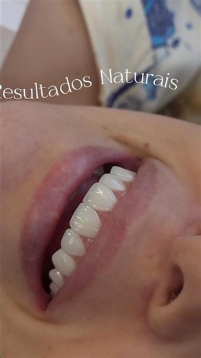Porque sou referência em lentes de resina no ABC paulista