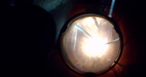 Triple Procedure for a PVR Stage D Retinal Detachment - Eyetube