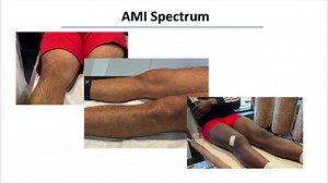 4.2K views · 34 reactions | How to classify AMI in clinical practice?...