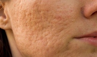 Acne Scarring Treatment