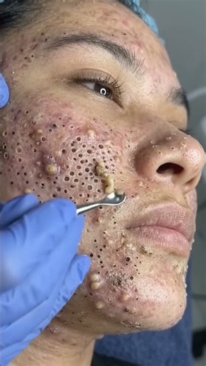 OMG 😱 Huge blackheads removal! #blackheadsremove #foryou #treandingvideo #viralvideo