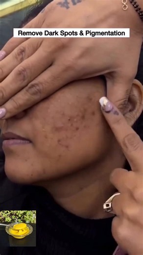How To Remove Acne Pimple On Face At Home 🫶 | Remove Darkspots & Pigmentation #skincare #shorts