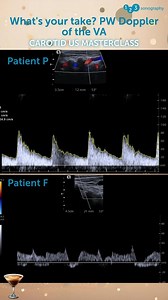 Do you know why it's important to perform an ultrasound of the vertebral arteries and the main challenges? Imaging of the vertebral arteries can sometimes be technically challenging as they are smaller, lie further in the far field, and are partially hidden behind the bony structures of the transverse processes. However, with experience and the correct technique, it is possible to visualize and identify the vertebral artery in the vast majority of patients: The segment V2 can be seen in 98% of p