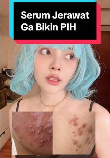 Serum Dorskin Atasi PIH & PIE, Bekas Jerawat Cepat Hilang