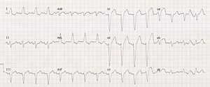 How to Diagnose Left Bundle Branch Block with ECG