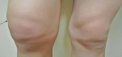 Genoux gonflés: remèdes naturels pour épanchement de synovie - Remèdes de Grand-Mère