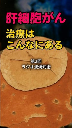 肝細胞がん、治療はこんなにある ②ラジオ波焼灼術（RFA）#肝細胞癌 #ラジオ波焼灼術 #RFA #肝臓がん #がん治療 #医療解説 #shorts