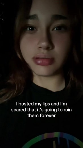 I look very bad rn i know but it hurts and its bruised and i cant talk😭 @audrey 🍊🌞🌺 audrey knows…😔#bruised #lips #busted